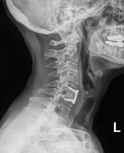 X-Ray of a Patient who has had an ACDF