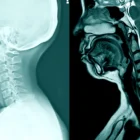 Acute Disc Herniation