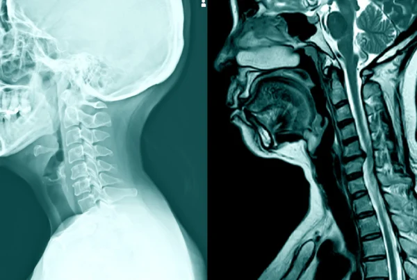 Acute Disc Herniation