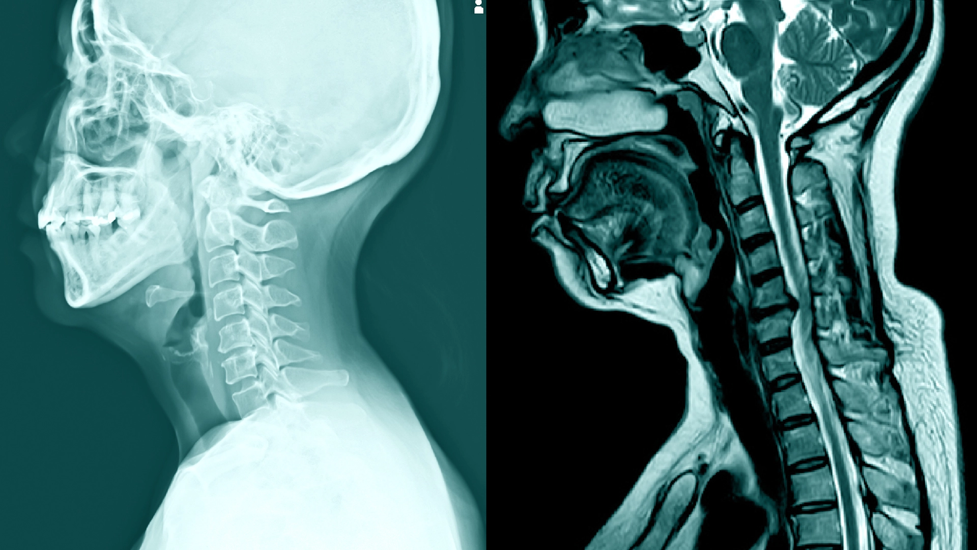 Understanding Cervical Fusion: An Overview