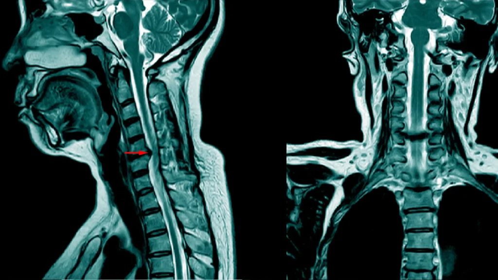 Patient with a herniated disc, with a red arrow pointing toward the pertinent area