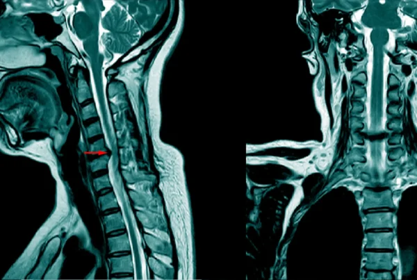 Patient with a herniated disc, with a red arrow pointing toward the pertinent area