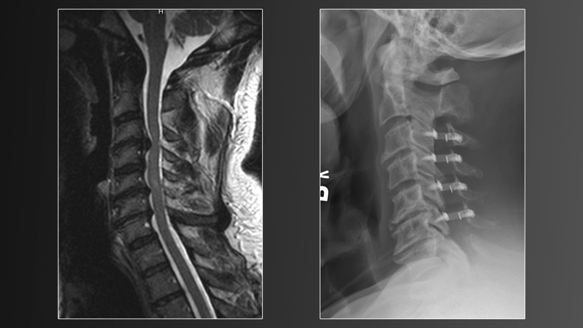 Cervical Laminoplasty: A Simple Guide to Neck Surgery