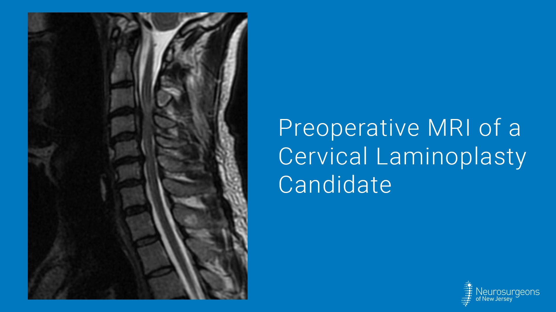 Preoperative MRI of a Cervical Laminoplasty Candidate