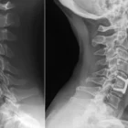 One and Two Level ACDF X-Rays