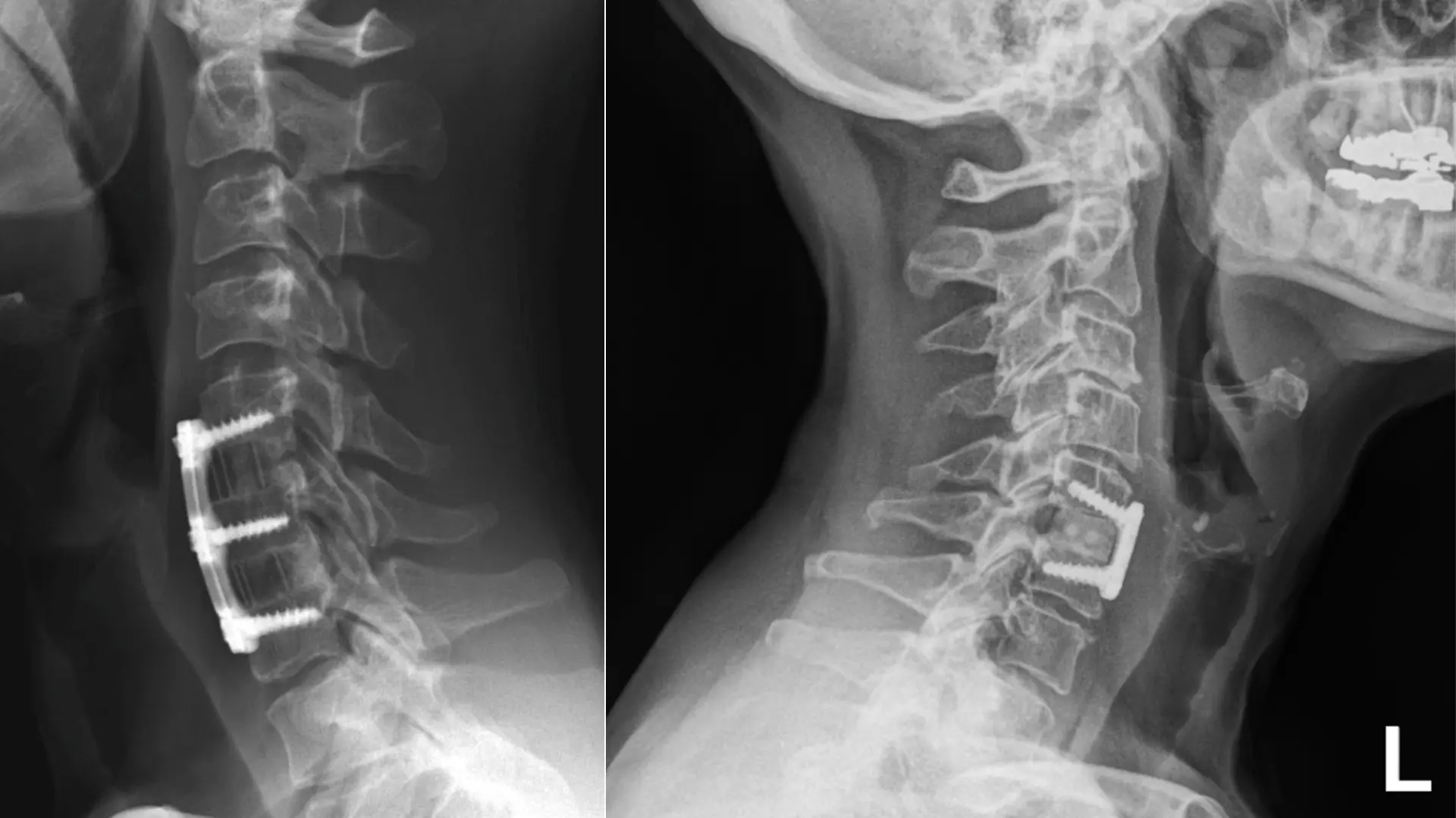 Anterior Cervical Discectomy and Fusion (ACDF): Recovery, Benefits, and Intricacies