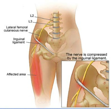 femoral nerve injury - Neurosurgeons of New Jersey