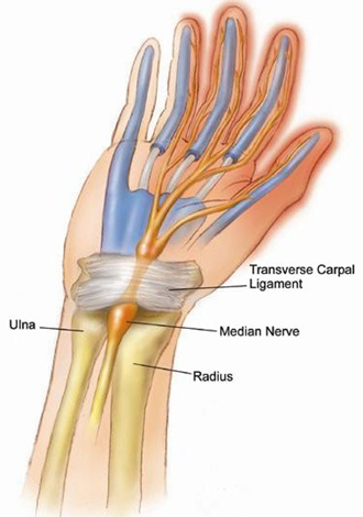 median nerve entrapment | Neurosurgeons of New Jersey