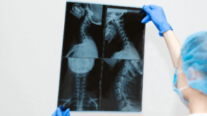 Life After Anterior Cervical Disc Replacement Surgery