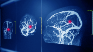 What is brain aneurysm surgery?