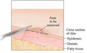 skin biopsy - Neurosurgeons of New Jersey